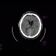 Subdural hematoma, tentorium cerebelli: CT - Computed tomography